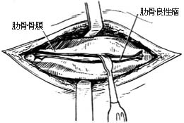 肋骨肿瘤切除术图片