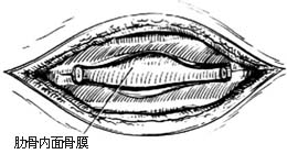 肋骨肿瘤切除术图片