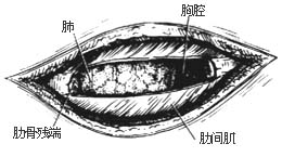 肋骨肿瘤切除术图片