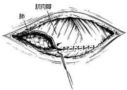 肋骨肿瘤切除术图片