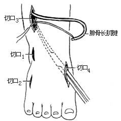 腓骨长肌腱转移术图片