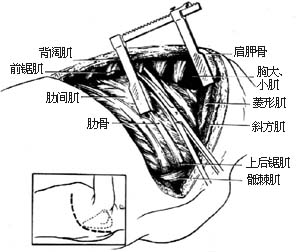 胸廓外成形术图片