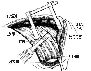 胸廓外成形术图片