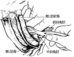 胸廓外成形术图片