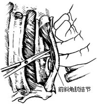 胸廓外成形术图片