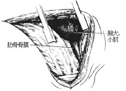 胸廓外成形术图片