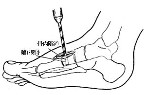 腓骨长肌腱转移术图片