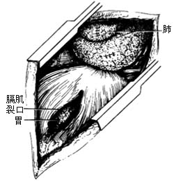 膈疝修补术图片