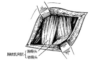 胸锁乳突肌切断术图片