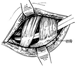 胸锁乳突肌切断术图片