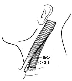 胸锁乳突肌切断术图片