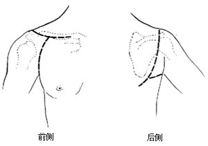 肩胛带截肢术图片