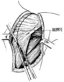 肩胛带截肢术图片