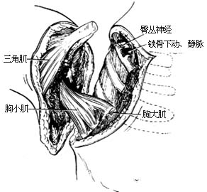 肩胛带截肢术图片