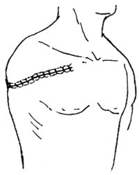 肩胛带截肢术图片