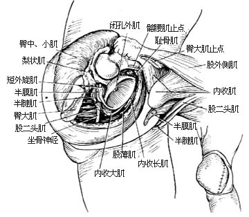 髋关节离断术图片