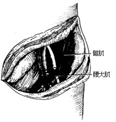 半骨盆截肢术图片