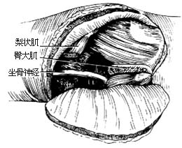 半骨盆截肢术图片