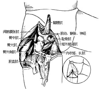 髋关节离断术图片