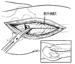 转子间切骨术图片