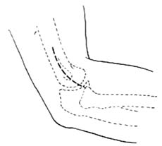 肘内翻切骨术图片