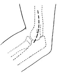 肘外翻切骨术图片