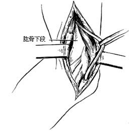 肘外翻切骨术图片