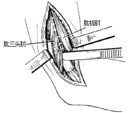 肘内翻切骨术图片