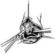 主动脉瓣置换术图片