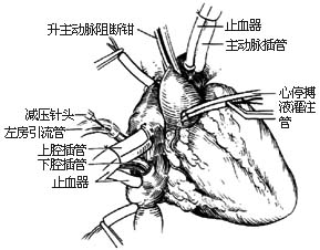 建立体外循环图片