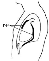 心包切开引流术图片