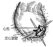 心包切除术图片