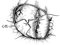 心包切除术图片