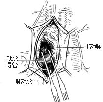 未闭动脉导管结扎术和切断缝合术图片