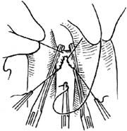 未闭动脉导管结扎术和切断缝合术图片