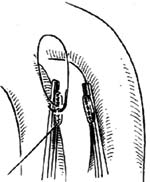 未闭动脉导管结扎术和切断缝合术图片