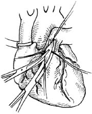 肺动脉瓣狭窄切开术图片