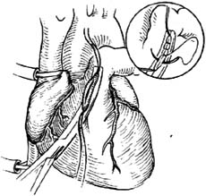 肺动脉瓣狭窄切开术图片