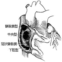 房间隔缺损修补术图片