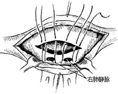 房间隔缺损修补术图片