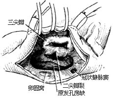 房间隔缺损修补术图片