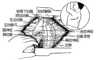 未闭动脉导管结扎术和切断缝合术图片