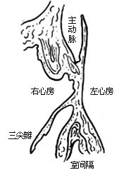 室间隔缺损修补术图片