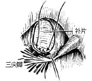 室间隔缺损修补术图片