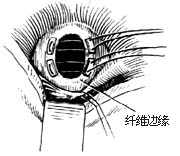 室间隔缺损修补术图片