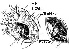 室间隔缺损修补术图片