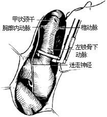 法乐四联症纠治术图片