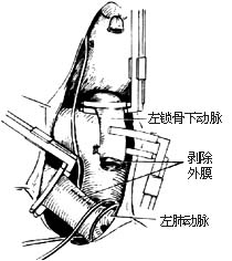 法乐四联症纠治术图片