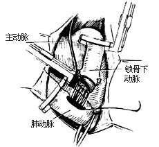 法乐四联症纠治术图片