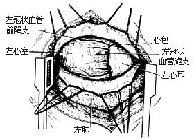 闭式二尖瓣交界分离术图片